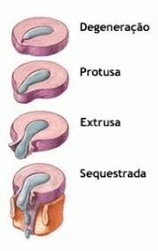 A hrnia de disco  uma disfuno da coluna vertebral que acontece quando o disco se "desloca" em direo a medula 