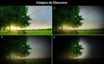 Glaucoma: O Ladro Silencioso da Viso